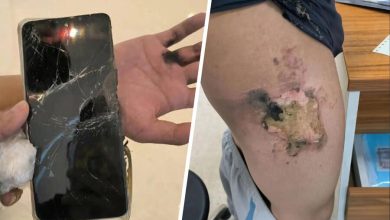 Фото - Мужчина получил серьезные ожоги при взрыве смартфона Redmi Note 11T Pro